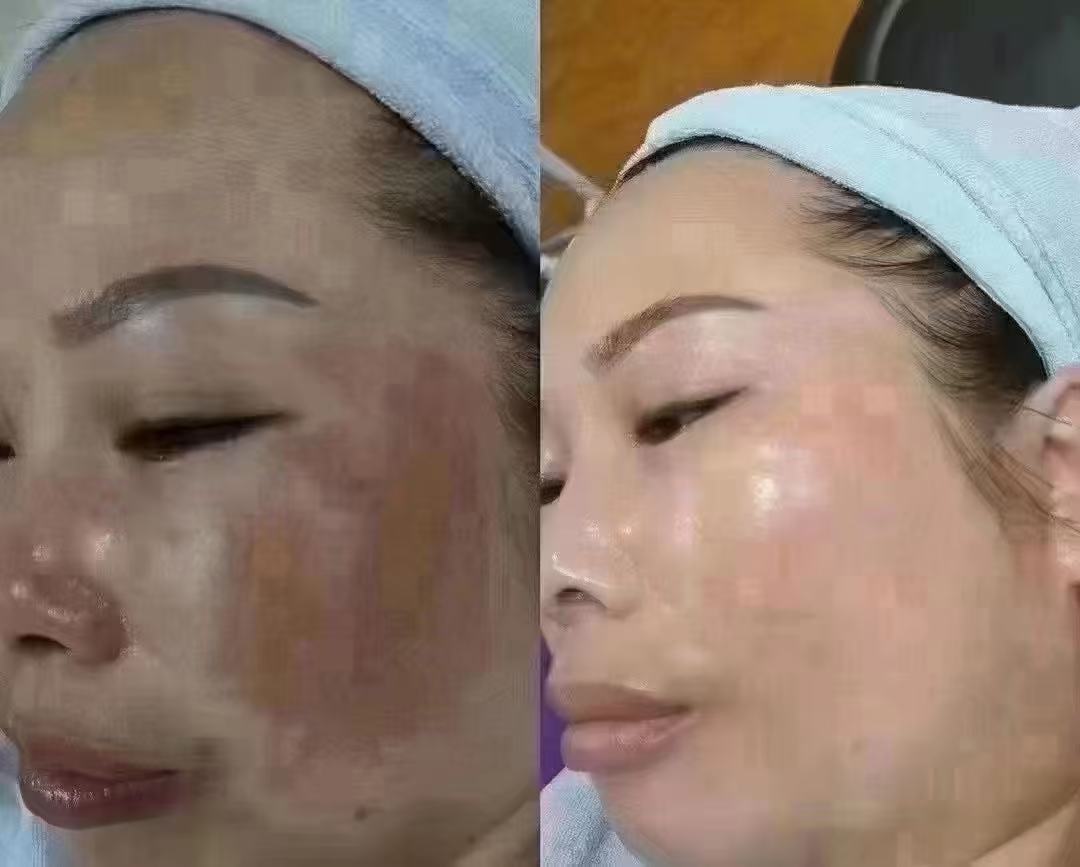 面部案例